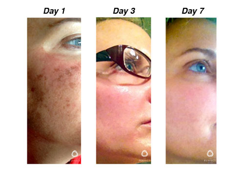 Day 1, Day 3, and Day 7 results of young Caucasian woman with lightened brown skin pigmentation with The Perfect Derma™ Peel.