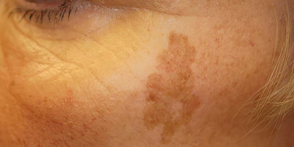 Sun Spots And Brown Pigmentation Removal Cibolo Creek Dermatology Group