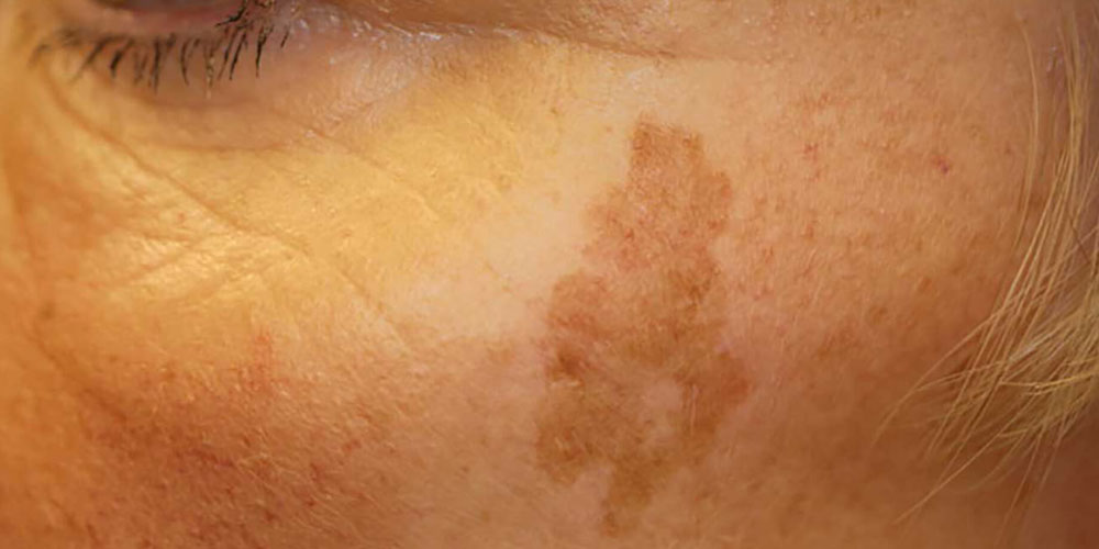 sun-spots-brown-pigmentation-removal-cibolo-creek-dermatology-group