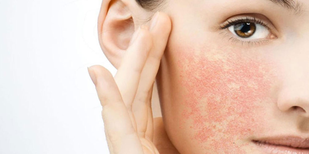 Close up of womans cheek and ear with red skin rash.