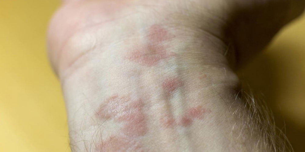 Closeup of mans wrist with eczema.