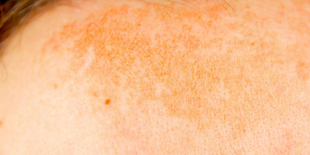 Closeup of skin with dark spot of hyperpigmentation.
