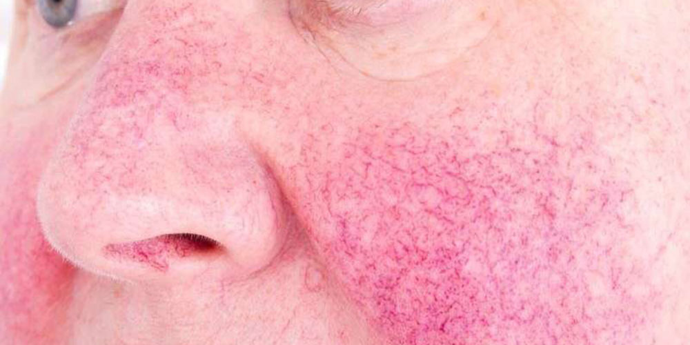 Closeup of mans cheek and nose with rosacea.