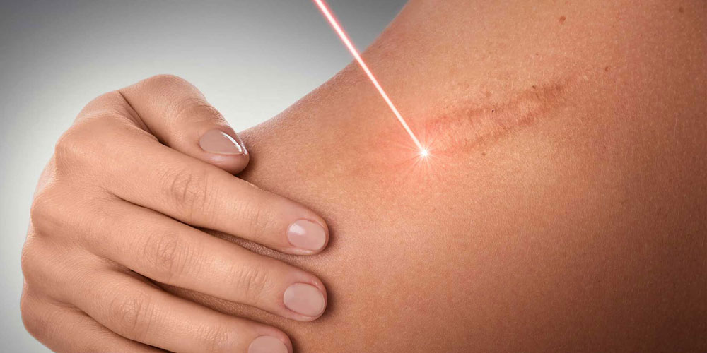 Laser removing scar on womans shoulder.