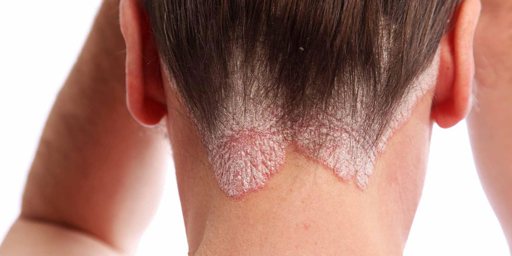 Nape of womans neck with severe psoriasis in hairline.