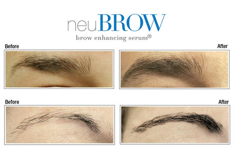 Before and after brow re-growth using neuBROW® brow enhancing serum.