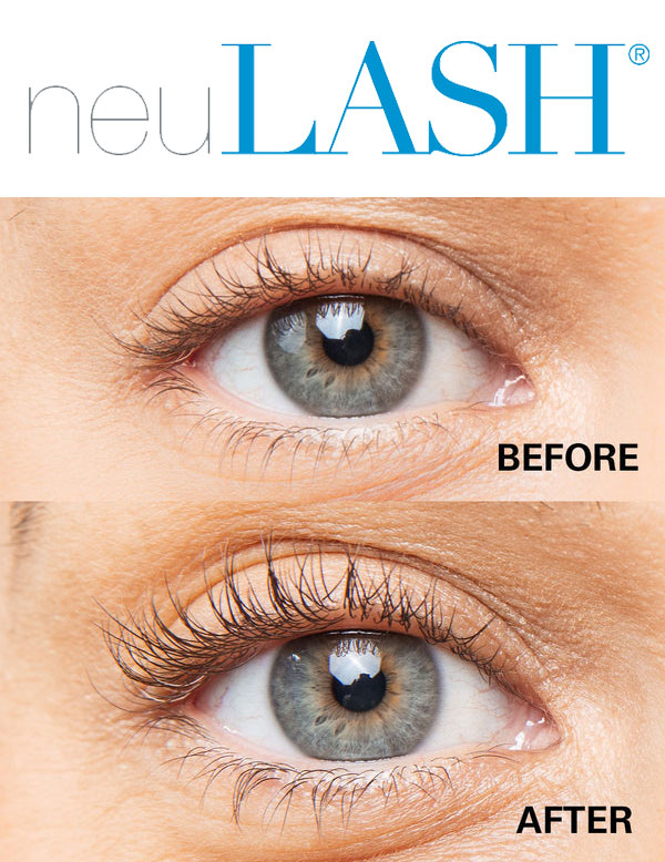 Before and after lash growth using neuLASH® lash enhancing serum.