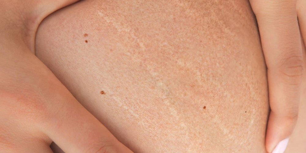Stretch marks on skin.