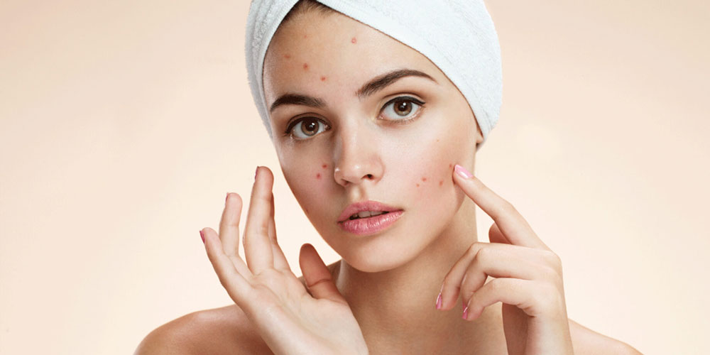 Young girl with white towel on her head pointing at face acne.