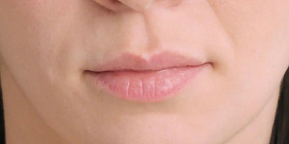 RESTYLANE® Fillers | Cibolo Creek Dermatology Group
