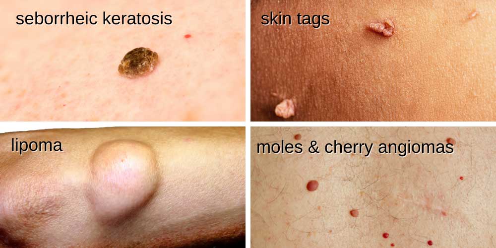 benign skin lesions