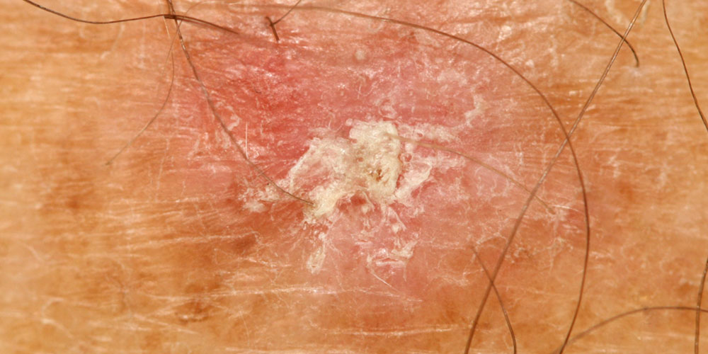 Close up of actinic keratosis