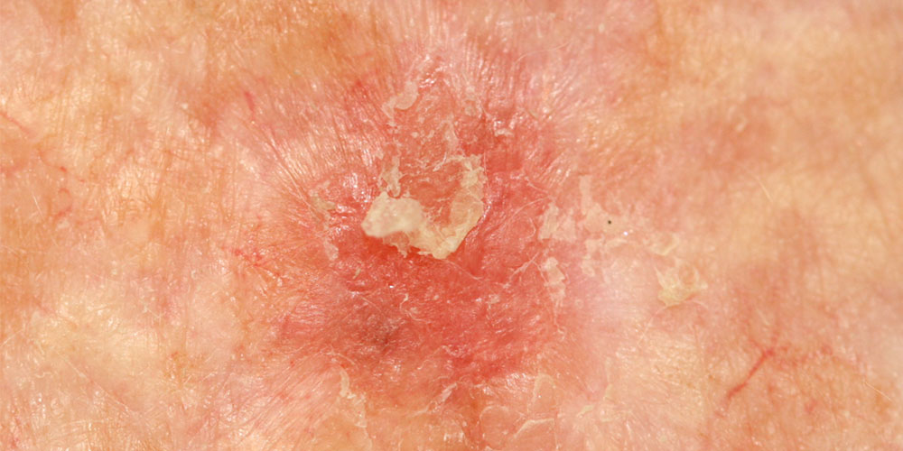 Close up of actinic keratosis