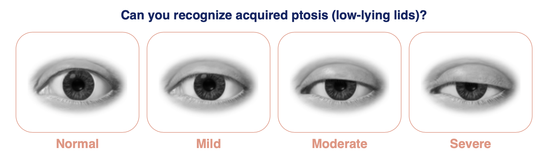 Drawing of an eye from normal to severe with question: can you recognize low-lying lids?