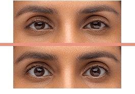 Before and after images of eyelids with Upneeq